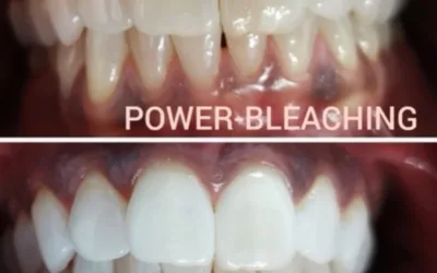 Power-Bleaching
