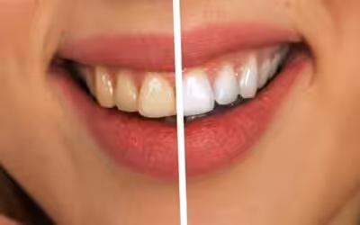 Zahnbleaching