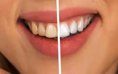 Bleaching