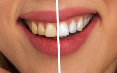 Bleaching