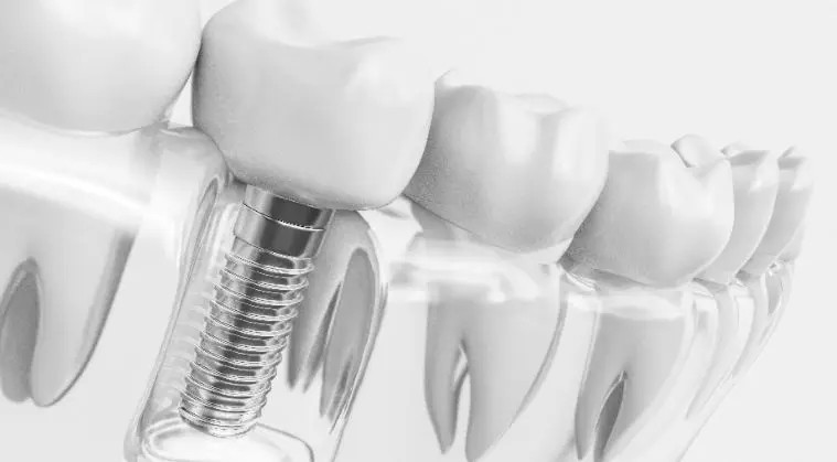 Implantat