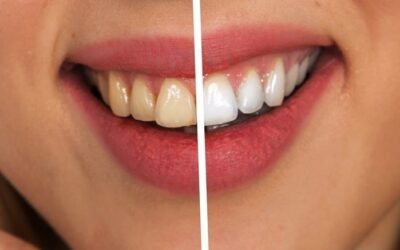 Bleaching