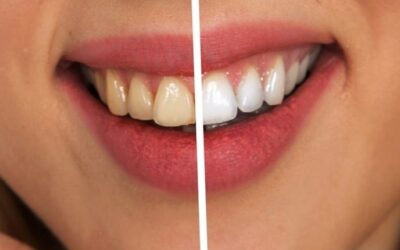 Bleaching