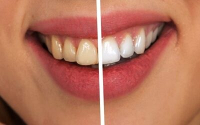 Bleaching