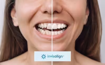 Invisalign