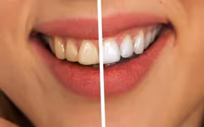 Zahnaufhellung/ Bleaching
