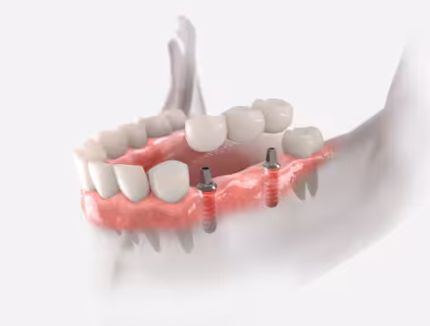 Implantatbrückerücke