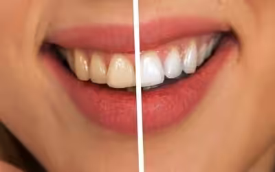 Bleaching