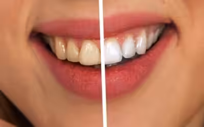 Bleaching