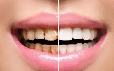 Zahnbleaching