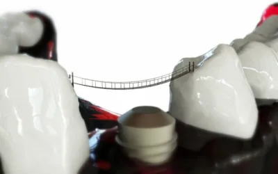 Zahn Implantat / Zahnarzt Biel