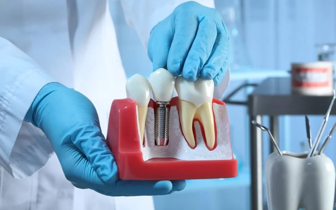 Implantaten in unserer Zahnarztpraxis in Biel!