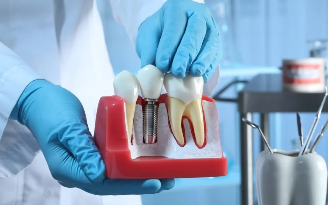 écouvrez les avantages des implants dans notre cabinet dentaire de Bienne