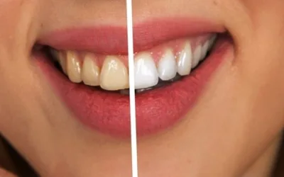 Bleaching mit Phillips Zoom