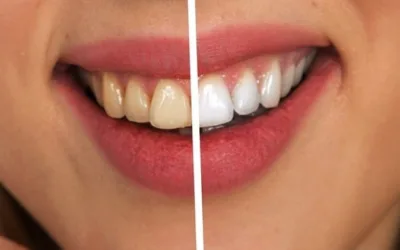 Zahn Bleaching mit Phillips Zoom beim Zahnarzt Biel