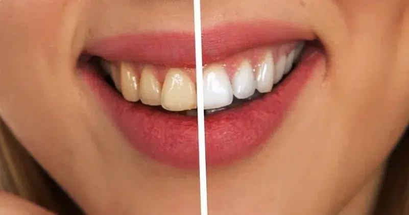 Zahn Bleaching mit Phillips Zoom beim Zahnarzt Biel